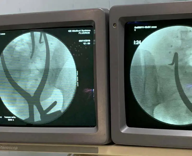 Cirugía de columna en Guadalajara